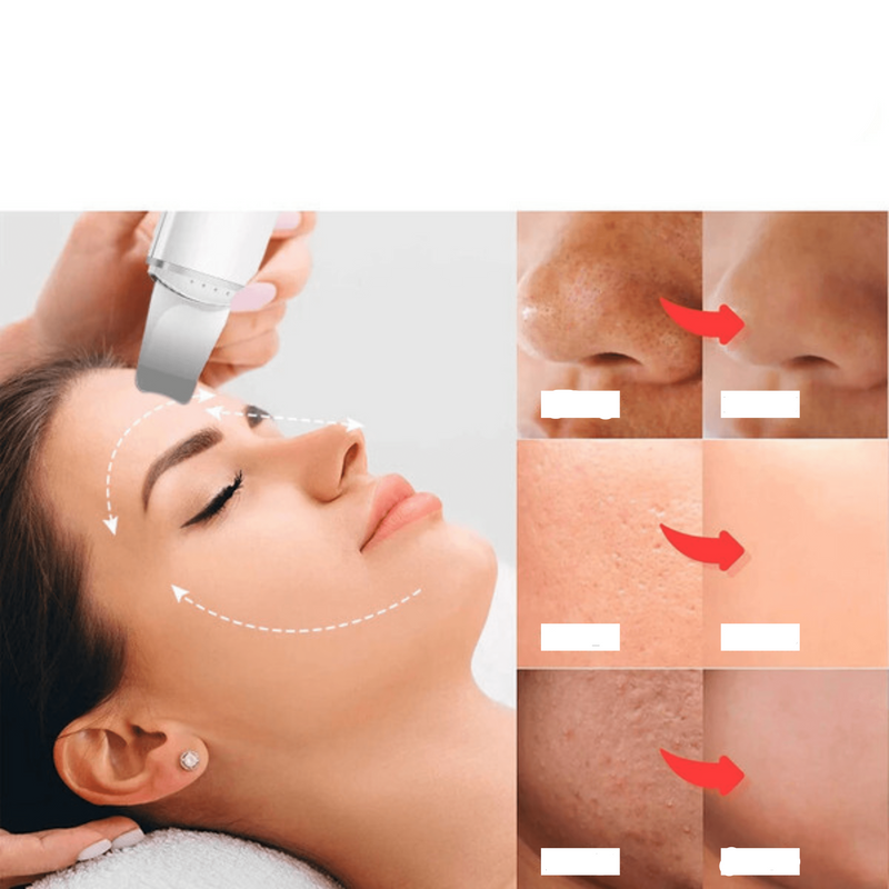 Limpador Facial | Tecnologia  Ultrassônica | Sua face jovial e livre das impurezas